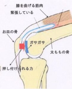 ひざ関節太ももの骨がガサガサになっている状態