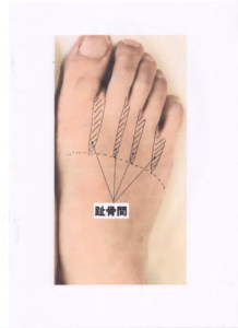 足の趾骨間の写真